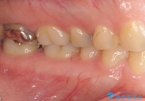 [フルジルコニアクラウン] 老朽化した銀歯を白くの治療前