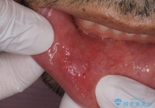 唇を噛んでしまった 粘液嚢胞の摘出の治療後