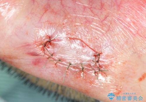 唇を噛んでしまった 粘液嚢胞の摘出の治療中