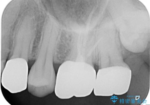 他院による虫歯治療(ドックスベストセメント)の再治療の治療後