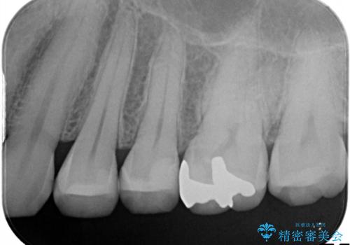 昔の詰め物のなかで広がる虫歯。セラミックインレーの治療後
