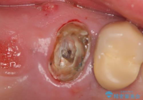 インプラント(ストローマン) 抜歯後の欠損補綴の治療前