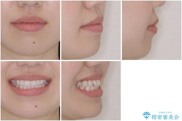 留学前に矯正治療 目立たないワイヤー装置でのスピード矯正の治療前(顔貌)