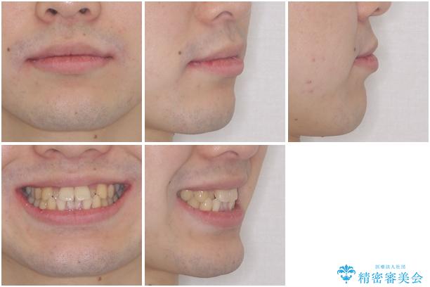 前歯のクロスバイト　インビザラインによる矯正治療の治療前（顔貌）