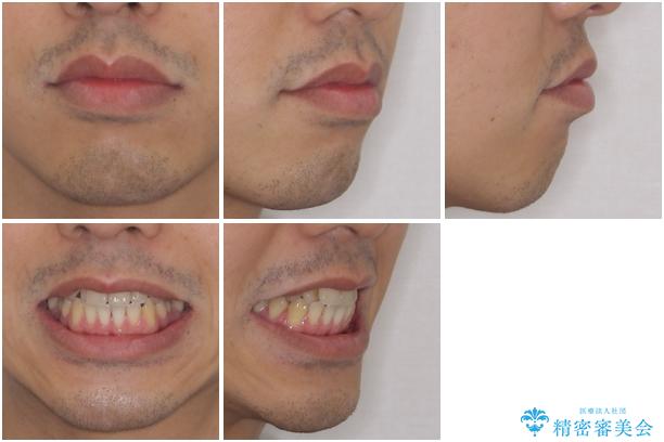 矯正歯科治療と前歯の歯肉移植術の治療前(顔貌)