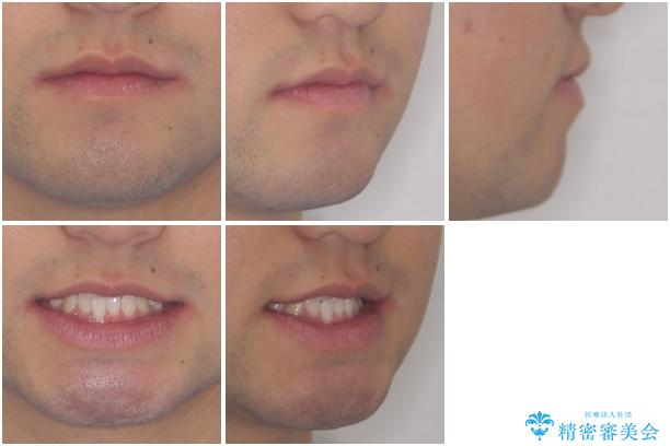 美容歯科でも断られた 著しい前歯のクロスバイトをワイヤー矯正で改善の治療前(顔貌)