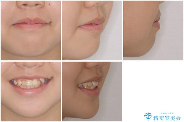 乳歯が残っている　目立たない装置での抜歯矯正の治療前（顔貌）