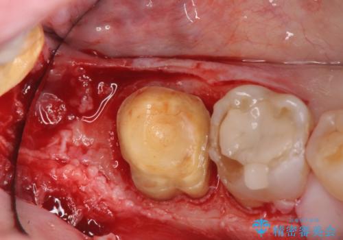 歯ぎしりによる異常に低い歯冠高径 歯周外科による解決の治療中