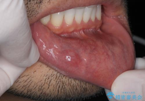唇を噛んでしまった　粘液嚢胞の摘出の症例 治療前