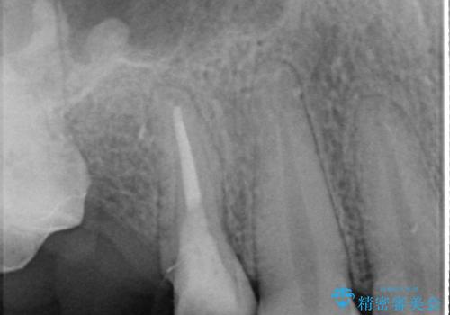 根管治療からのオールセラミックブリッジ装着の治療中
