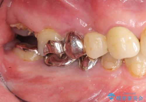 [強すぎる咬合力]　破折歯のインプラントによる咬合機能回復治療の治療前