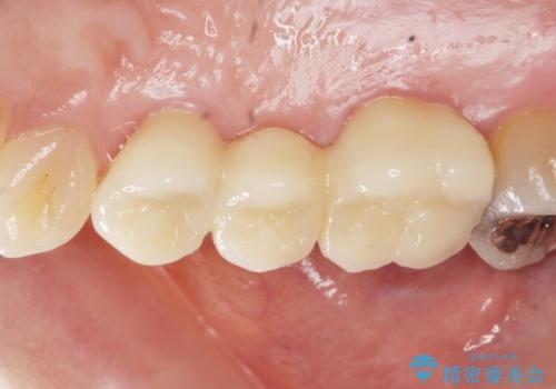 虫歯による歯の喪失　ジルコニアブリッジの製作の症例 治療後
