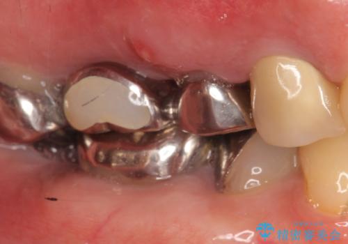 インプラント(ストローマン) 抜歯後の欠損補綴の治療前