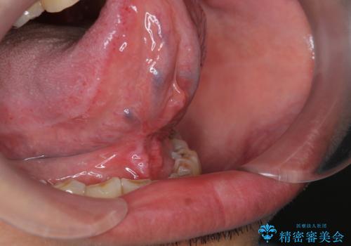 [日帰り手術] 舌小帯切除　滑舌をよくしたいの治療後