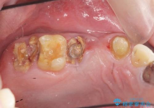 [強すぎる咬合力]　破折歯のインプラントによる咬合機能回復治療の症例 治療前