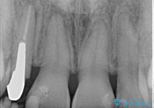 前歯が痛い。根管治療~オールセラミッククラウンの治療前
