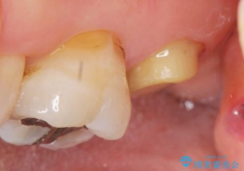 歯周外科で整備する安定したクラウン環境の治療中
