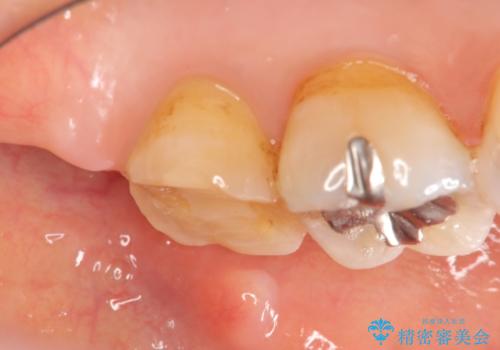 歯周外科で整備する安定したクラウン環境の治療前