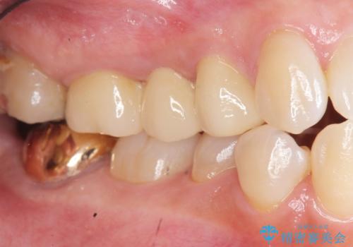 虫歯による歯の喪失　ジルコニアブリッジの製作の治療後