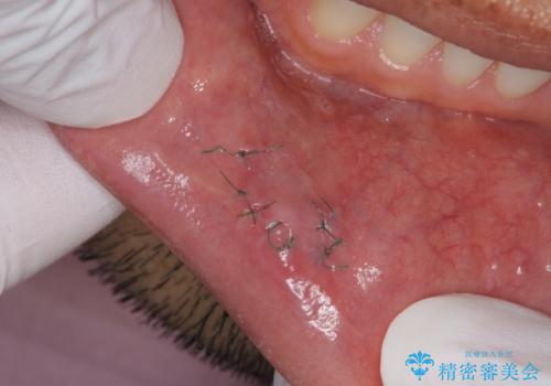 唇を噛んでしまった 粘液嚢胞の摘出の治療後
