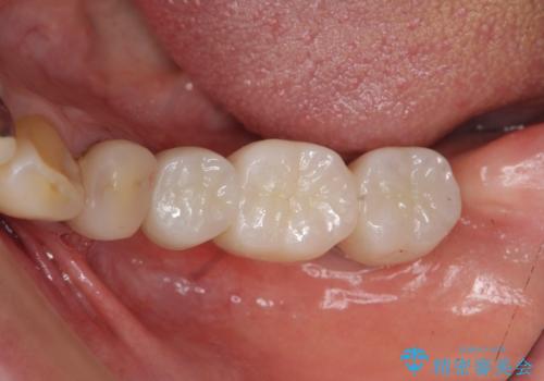 インプラントで咬合機能を取り戻すの治療後