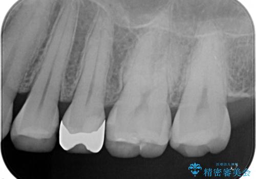 昔の詰め物のなかで広がる虫歯。セラミックインレーの治療前