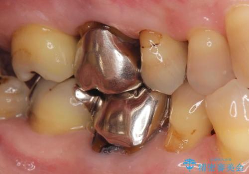 [銀歯の下の虫歯 ] 根管治療を伴う虫歯治療の治療前