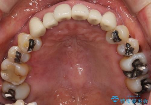 歯周病 インプラントによる咬合機能回復の治療前