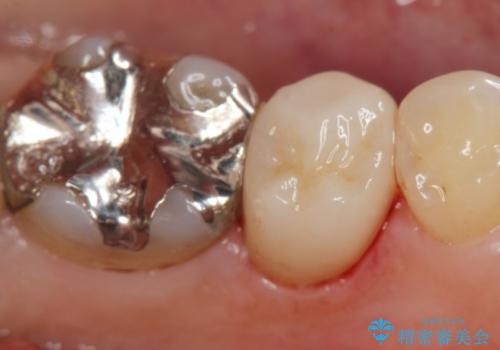 銀歯が外れ、内部に大きな虫歯の再発の症例 治療後