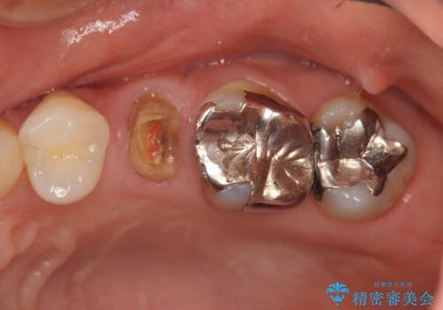 放置し崩壊した歯　セラミック治療による咬合機能回復の症例 治療前