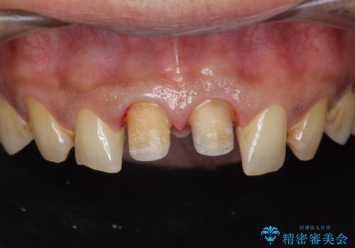 歯ぐきからの出血 膿が出る 前歯根管・セラミック治療の治療中