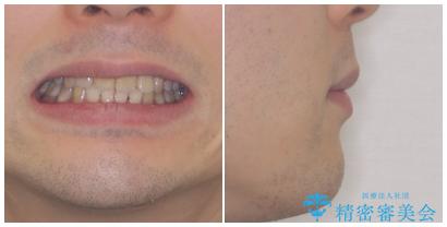 口元の突出感と叢生　ワイヤー装置による抜歯矯正の治療後（顔貌）