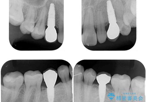欠損と残存乳歯 矯正治療とインプラント治療の治療後