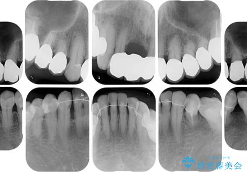 矯正治療と歯周外科処置を併用した審美歯科治療の治療後