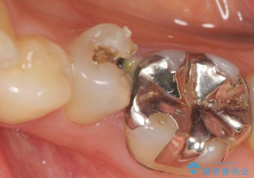 銀歯が外れ、内部に大きな虫歯の再発の治療前