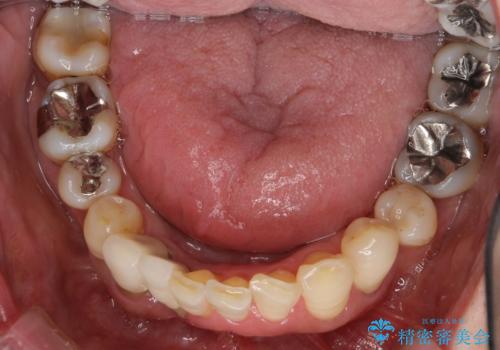 歯周病 インプラントによる咬合機能回復の治療前