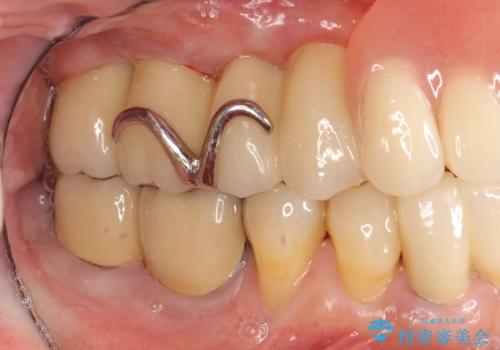 歯周病　インプラントによる咬合機能回復の治療後