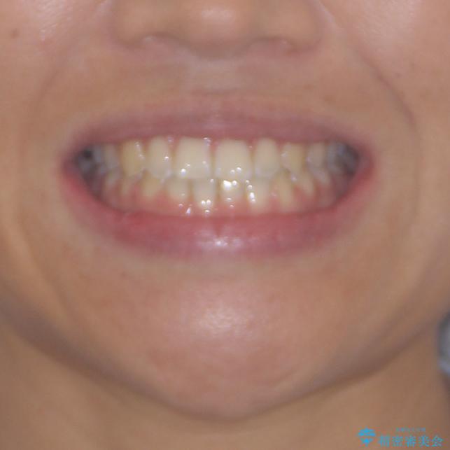 前歯の隙間を閉じたい　短期間でのワイヤー矯正の治療後（顔貌）