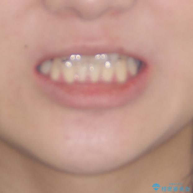欠損と残存乳歯　矯正治療とインプラント治療の治療前（顔貌）