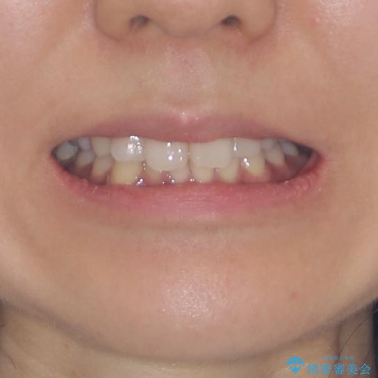 抜歯矯正の後戻り　インビザラインによる再矯正治療の治療前（顔貌）