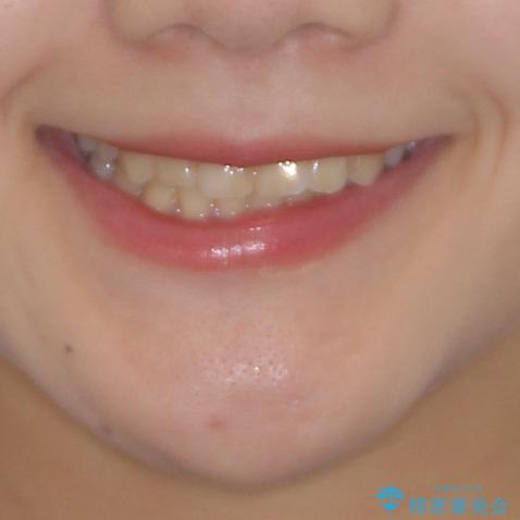 軽度な後戻りをインビザライン・ライトで改善の治療前(顔貌)