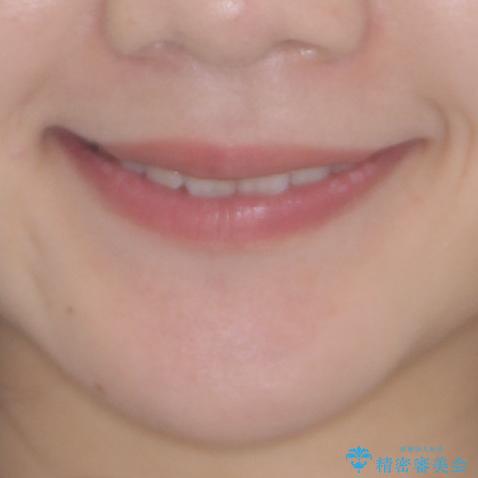 軽度な後戻りをインビザライン・ライトで改善の治療後(顔貌)