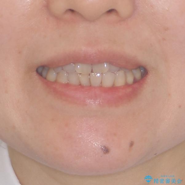 前歯の叢生と切端咬合　インビザラインによる矯正治療の治療前（顔貌）