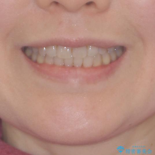前歯の叢生と切端咬合　インビザラインによる矯正治療の治療後（顔貌）