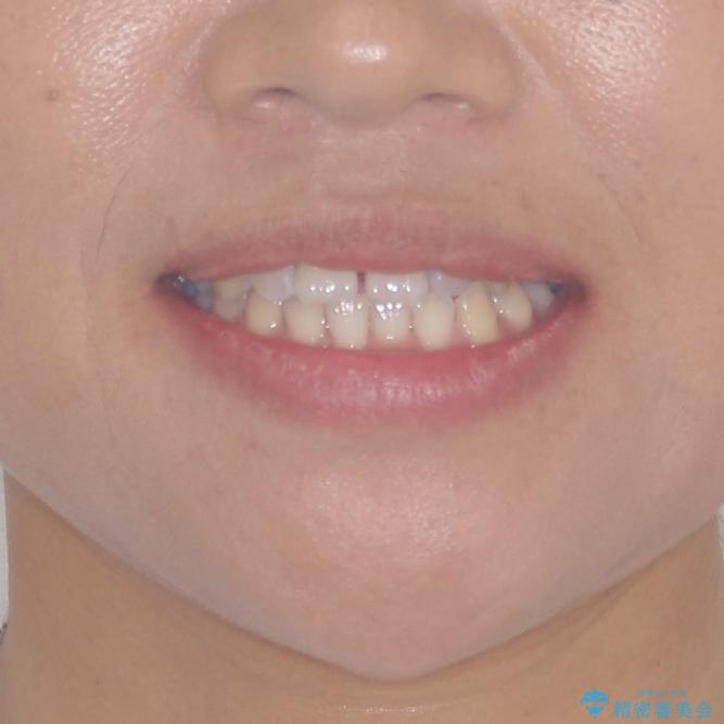 前歯の隙間を閉じたい　短期間でのワイヤー矯正の治療前（顔貌）