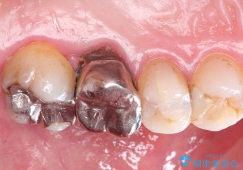 発見の難しい虫歯。根管治療から被せもの治療の症例 治療前