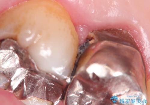発見の難しい虫歯。根管治療から被せもの治療