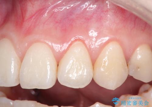 前歯の歯肉退縮　歯周形成外科(歯冠側移動術)の治療前