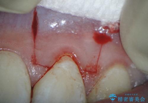 前歯の歯肉退縮　歯周形成外科(歯冠側移動術)
