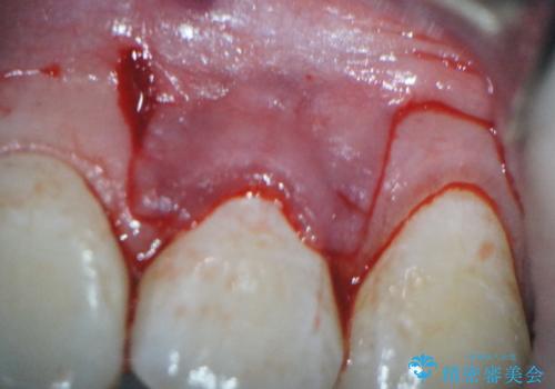 前歯の歯肉退縮　歯周形成外科(歯冠側移動術)の治療中